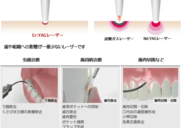 Er:YAG（エルビウムヤグ）レーザー